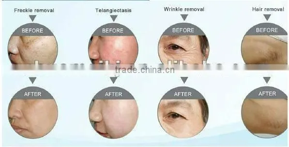 SHR IPL MACHINE HAIR REMOVAL Beauty & Personal Care