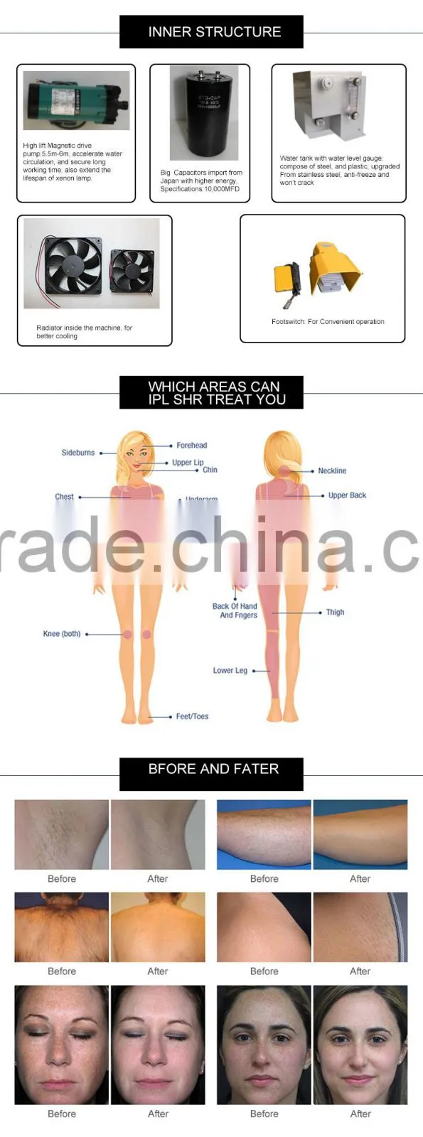 KES shr hair removal for body hair removal machine