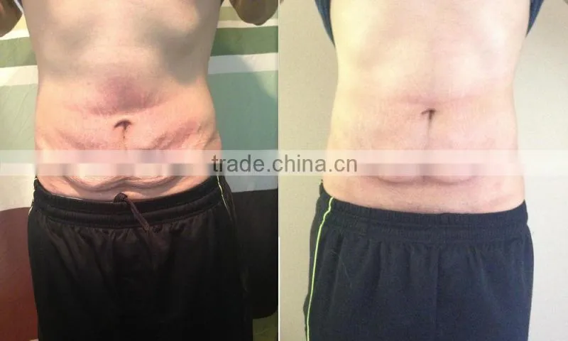 Top selling products 2015 Shock Wave Therapy cavitation rf vacuum salon equipment