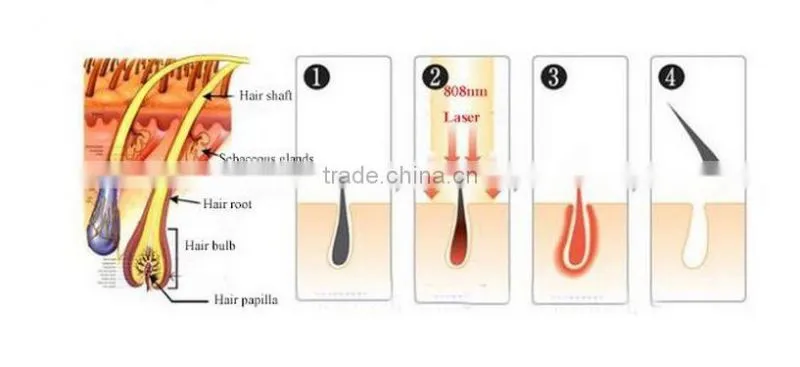 High quality laser hair removal home use