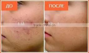 2016 Newest 2 handles OPT SHR IPL hair removal equipment/IPL SHR /3000W high power shr ipl machine