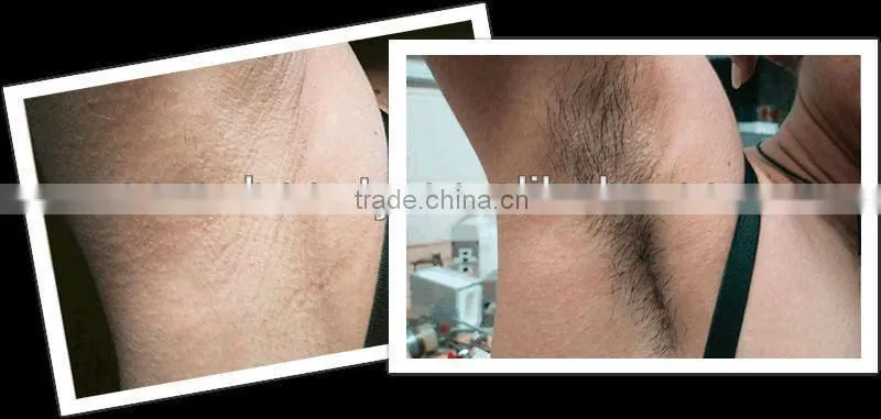 Professional ipl machine with reasonable ipl laser hair removal machine price