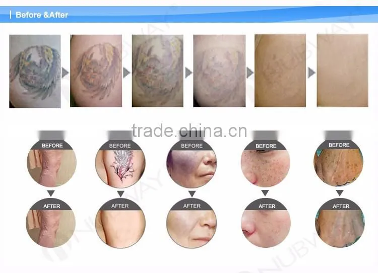 Single pulse 1500mj q-switched nd:yag laser tattoo removal laser machine