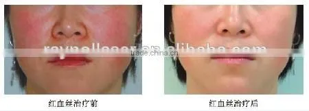 Companies Looking for Distributors Agents for Our Machine Turkish Language Medical Equipment for Spider Vein Removal