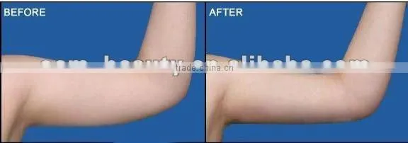 ultrasound liposuction rf tripolar reduce belly equipment F017
