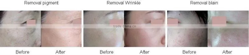 fractional co2 laser equipment/co2 fractional laser/fractional co2 laser