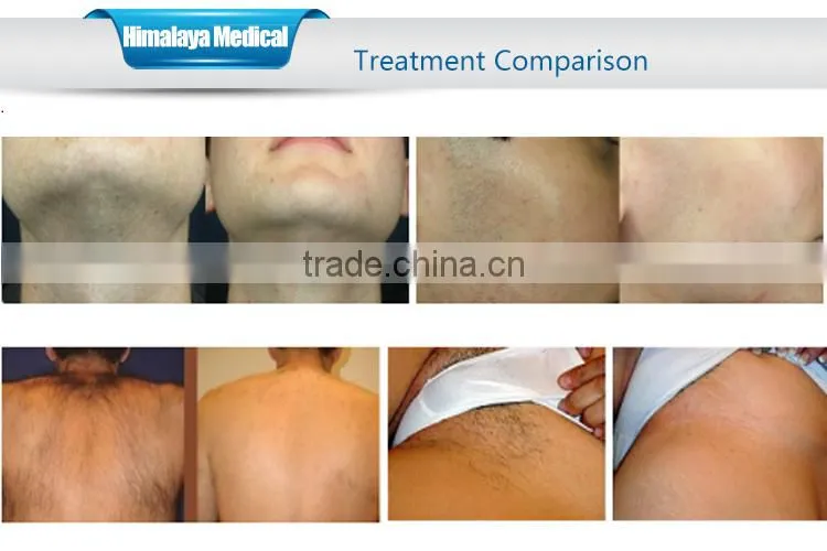 CE Approval Best Supplier SHR OPT IPL Hair Removal