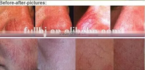 Portable Long Pulse Laser Hair Removal/Varicose vein/ Spider vein treatment