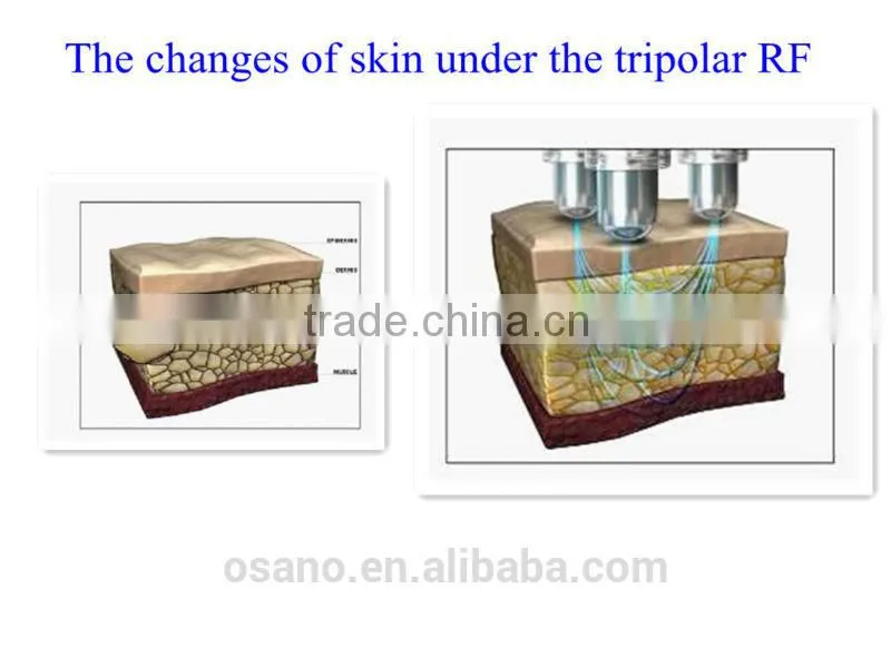Ultrasonic Cavitation Beauty Machine RF Skin Tightening Face Lifting System