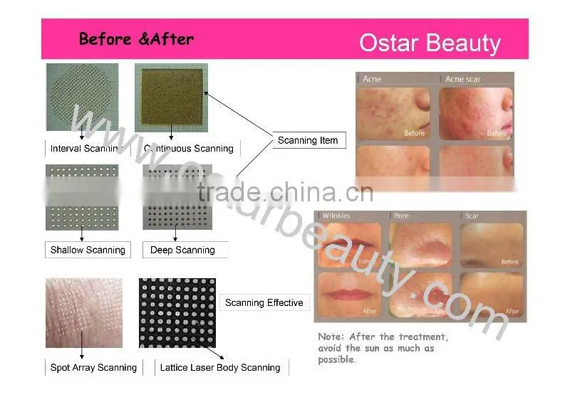 Porfessional CO2 Medical Laser Beauty Machine For Acne Removal