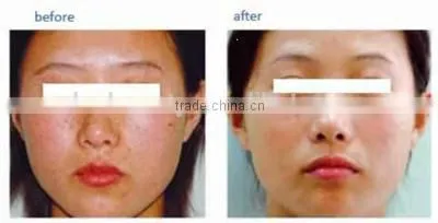2015 New Design Q-Switch Laser Tattoo Removal Laser
