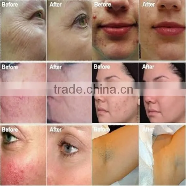 Portable hair tatoo removal skin care 4 in 1 machine