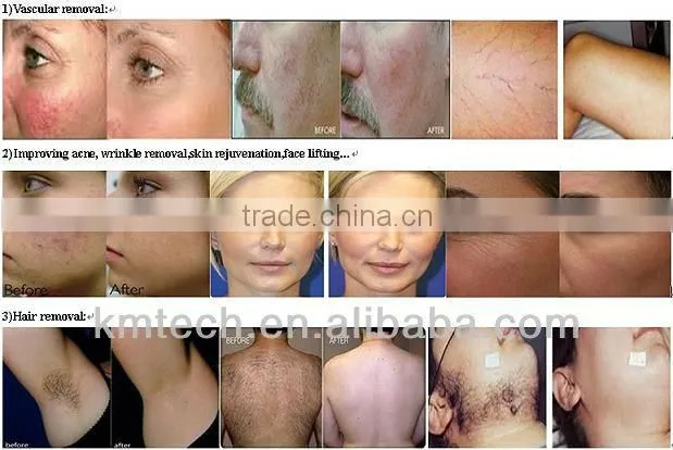 2013 Hot sale IPL photo epilation machines
