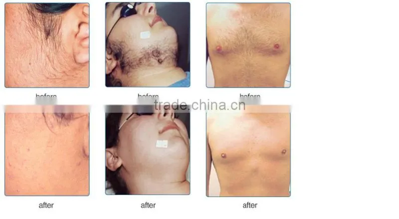 portable top quality elight machine needle free bio skin rejuvenation