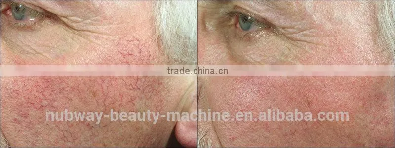 Best Quality Laser Hair Removal Machine IPL Laser Skin Rejuvenation IPL Machine Made In Germany