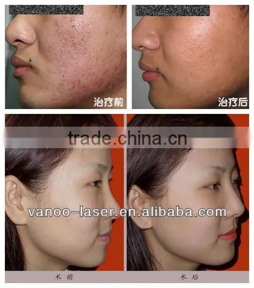 led facial treatment light