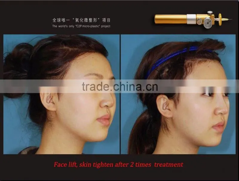 2016 Most popular CDT skin care equipment !!