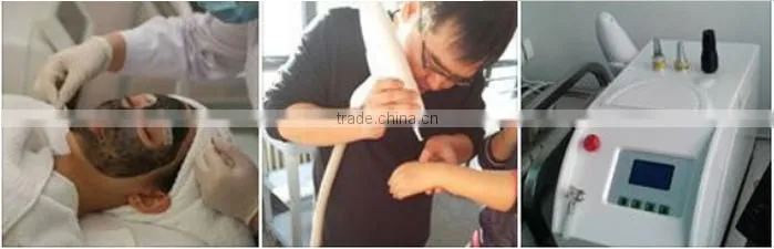 Sanhe ce 2 years warranty q switch nd yag laser tattoo removal medical laser nd yag equipment