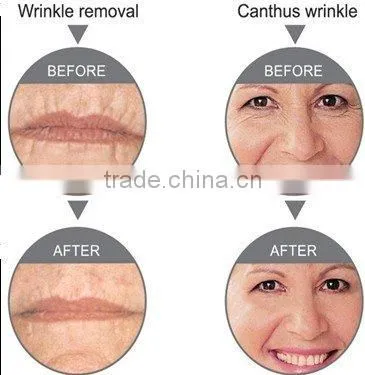 WL-13 Monopolar RF Wrinkle removal machine