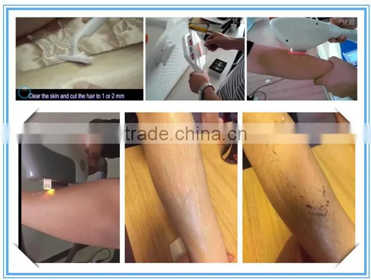 Permanent laser hair removal 808nm e light hair removal machine