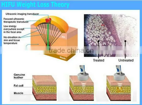 fat reduce newest hifu machine