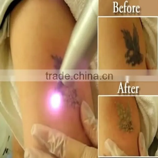Factory price tattoo removal costs for black , red, brown,colorful tattoo