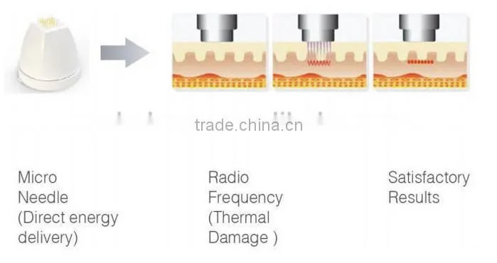 thermagic machine for home use, best rf skin tightening face lifting machine, fractional rf microneedle, thermagic