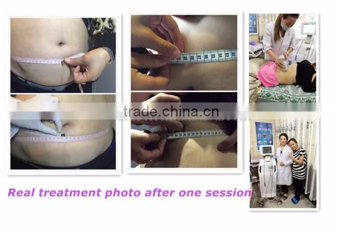 weight loss non-invasive skin tightening liposonix machine