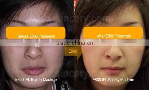 Best choose Beauty Salon Equipment ipl diode laser hair removal machine price