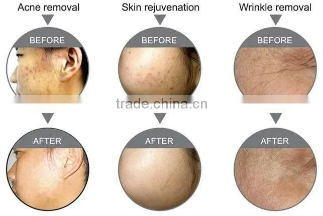 Multi-function beauty machine for hair removal skin rejuvenation with Vpl technology