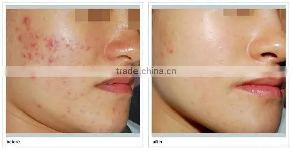 Hot Selling in USA Mini Red/Blue Light Machine For Skin Care, Skin Tighten, Acne Treatment/LED Light Therapy Machine