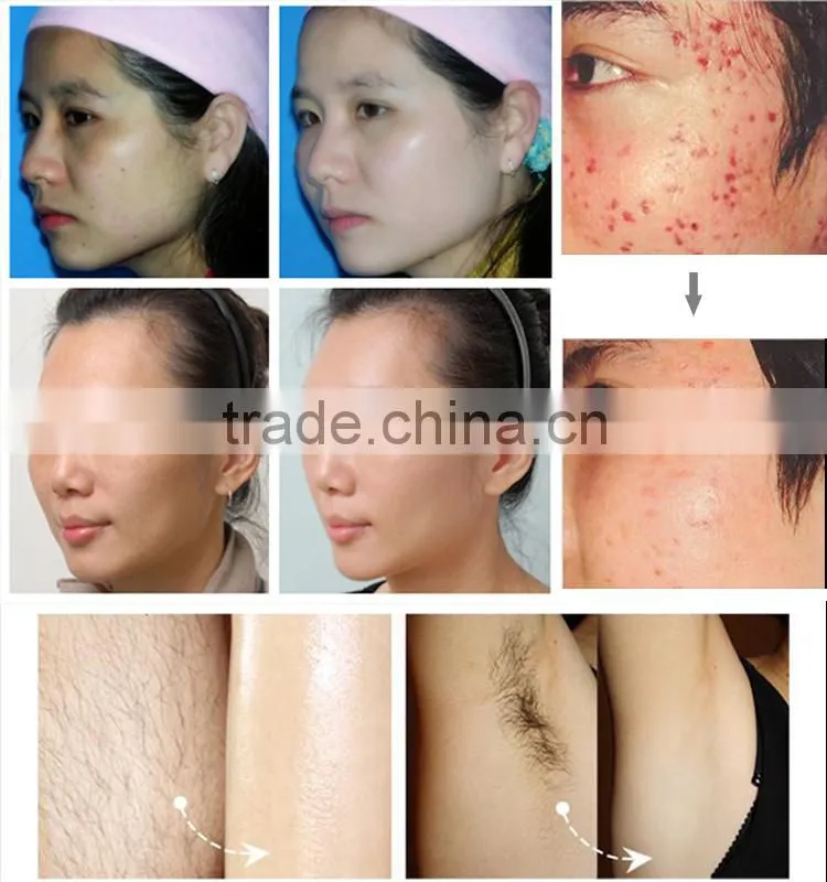 Hot sale IPL hair removal and skin rejuvenation machine/device! 755nm diode laser with TUV certificated ICE2
