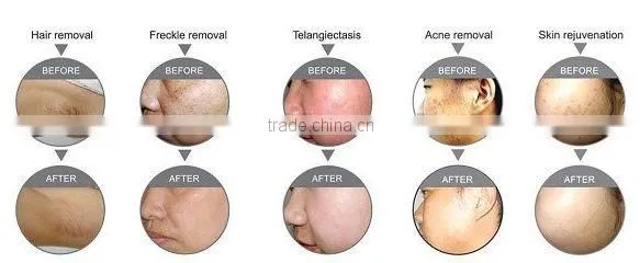 best professional ipl machine for hair removal