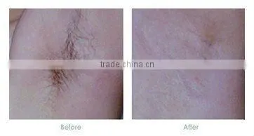 hot selling ipl age spots pigmentation hair removal machine ipl flash lamp rf nd yag laser machine for hair removal