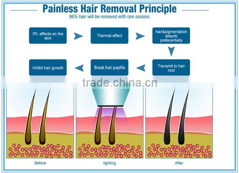 permanent diode laser 808nm hair removal pain free