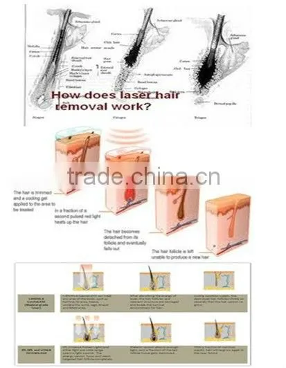 Immediately Result with Factory Promotion Price diode laser 808nm Hair Removal Machine