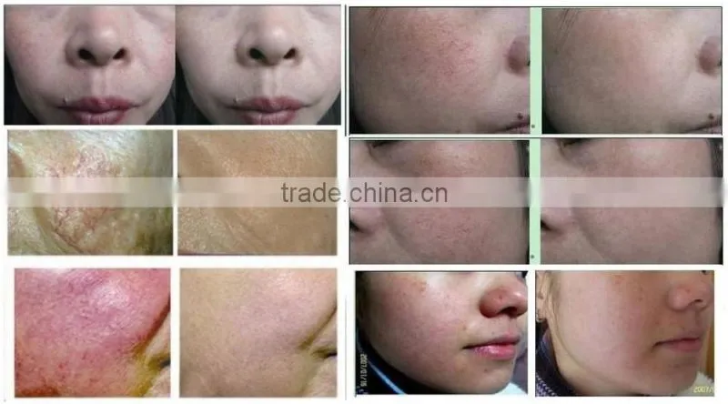 2015 Hot!!! Spider Vein /Vascular Removal /High Frequency Vascular Removal Machine for Beauty Spa