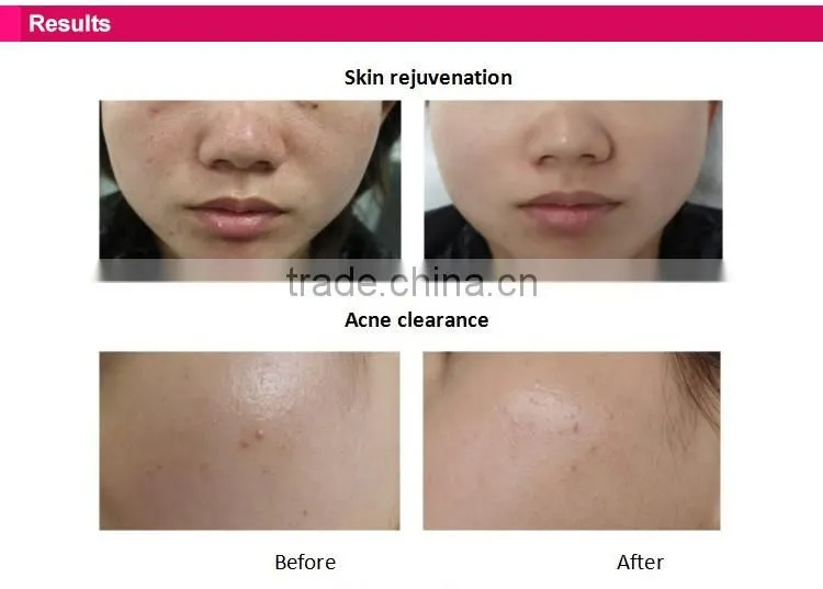 DEESS electronic equipment portable radio frequency face lift device beauty products for skin care