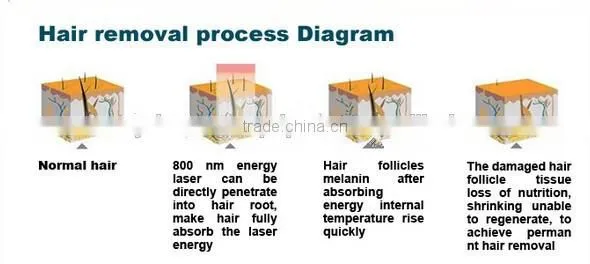 Newest mode portable diode laser hair removal professional 808nm diode laser hair removal machine