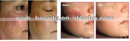 Pain free Vascular lesions treatment lasez hair removal equipment