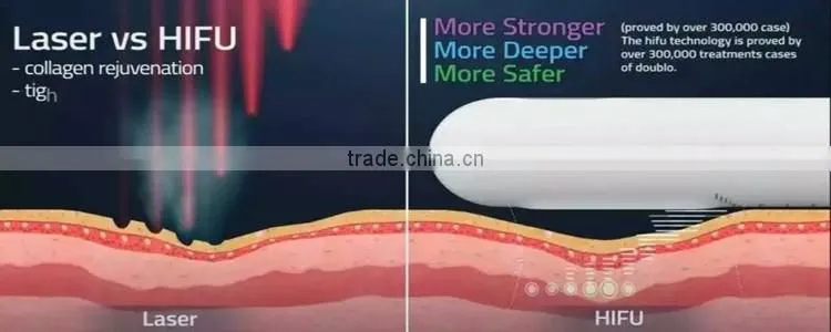 portable women sex hifu vaginal tightening machine with 10000shots