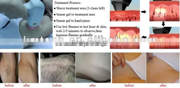 Top sale! portable 808nm diode laser hair removal machine