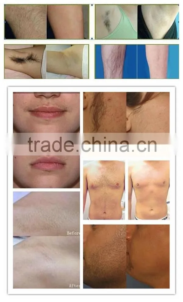 CE Approved Best Home Use IPL Photofacial Machie / Laser Hair Removal Varicose Vein Laser IPL