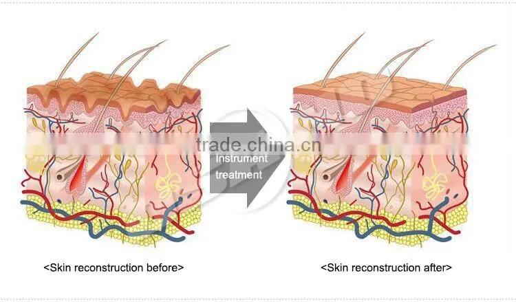 Worldwide Distributors Wanted IPL Hair Loss Treatment For Men With IPL Filter Machine Price