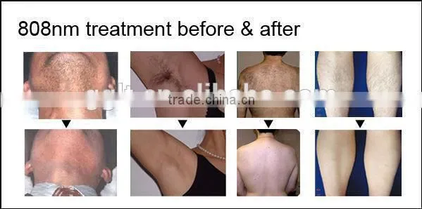 808 laser medical equipment in beauty and personal care