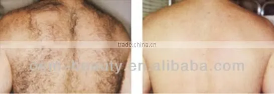 Sale! Intese pulse ipl laser machine hair reduction ipl machine