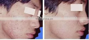 Manufacture Supplied Portable Hair Removal IPL Machine