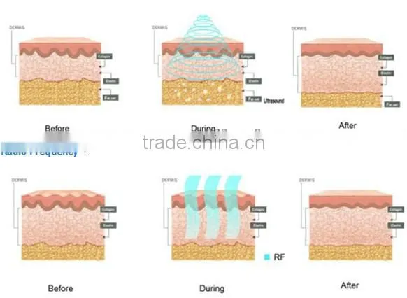 Ultrasonic Cavitation RF Thermotherapy Electrotherapy Weight Loss Equipment