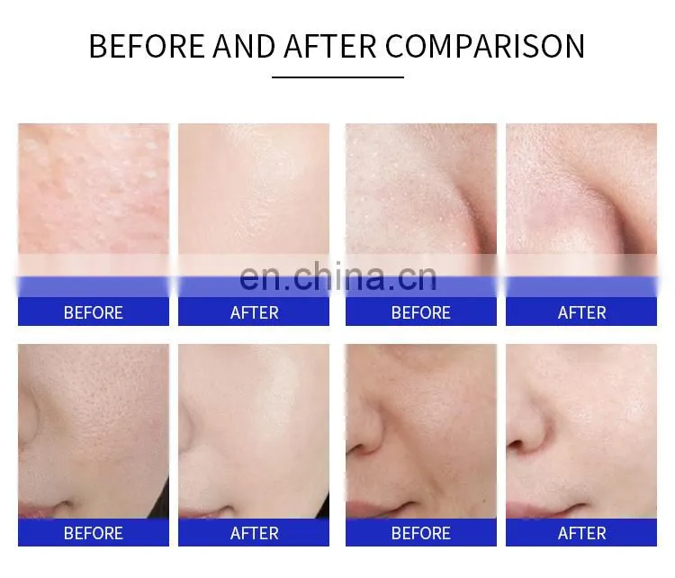 3 In1 Diamond Microdermabrasion Hydra Beauty Machine Facial Peeling Suction Oxygen Jet Skin Rejuvenation Dermabrasion Instrument