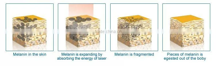 2016 latest laser softlight nd yag laser 1064 nm wavelength tattoo removal machine
